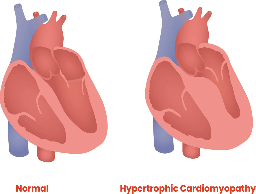 Kardiomiopatia przerostowa