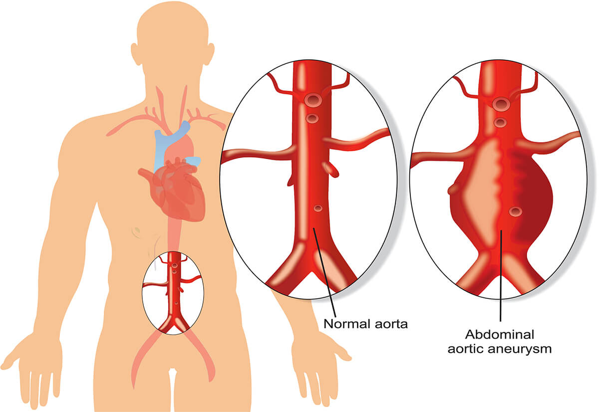 T Tniak Aorty Definicja Przyczyny Objawy Leczenie Sedimed