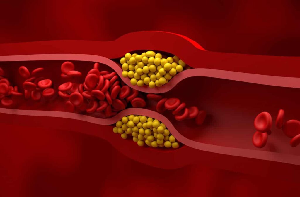 Hipertrójglicerydemia